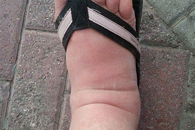 blog-obese-ankle01