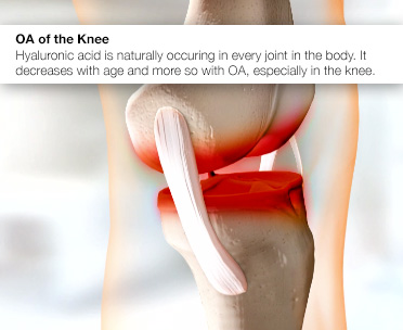 knee-injections-for-pain-hyaluronic-acid