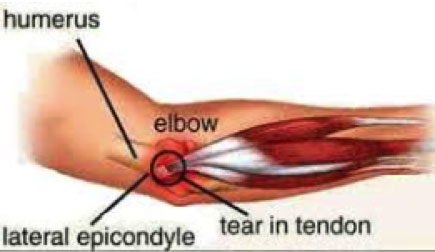 Stem Cell Injections can help heal tendon injuries