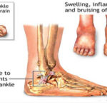 sports-injuries-ankle