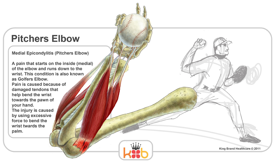 In response to the Exclusive if you can baseball elbow injuries Props ...