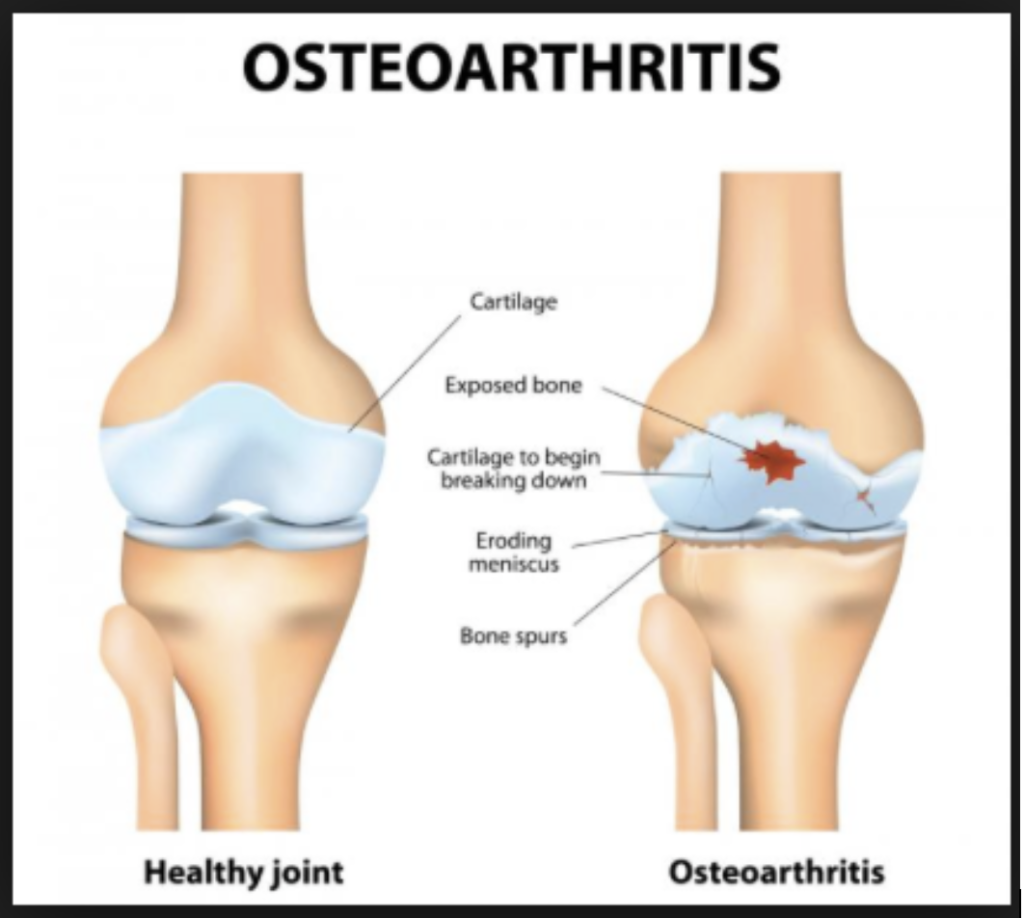 osteoarthritis-prp