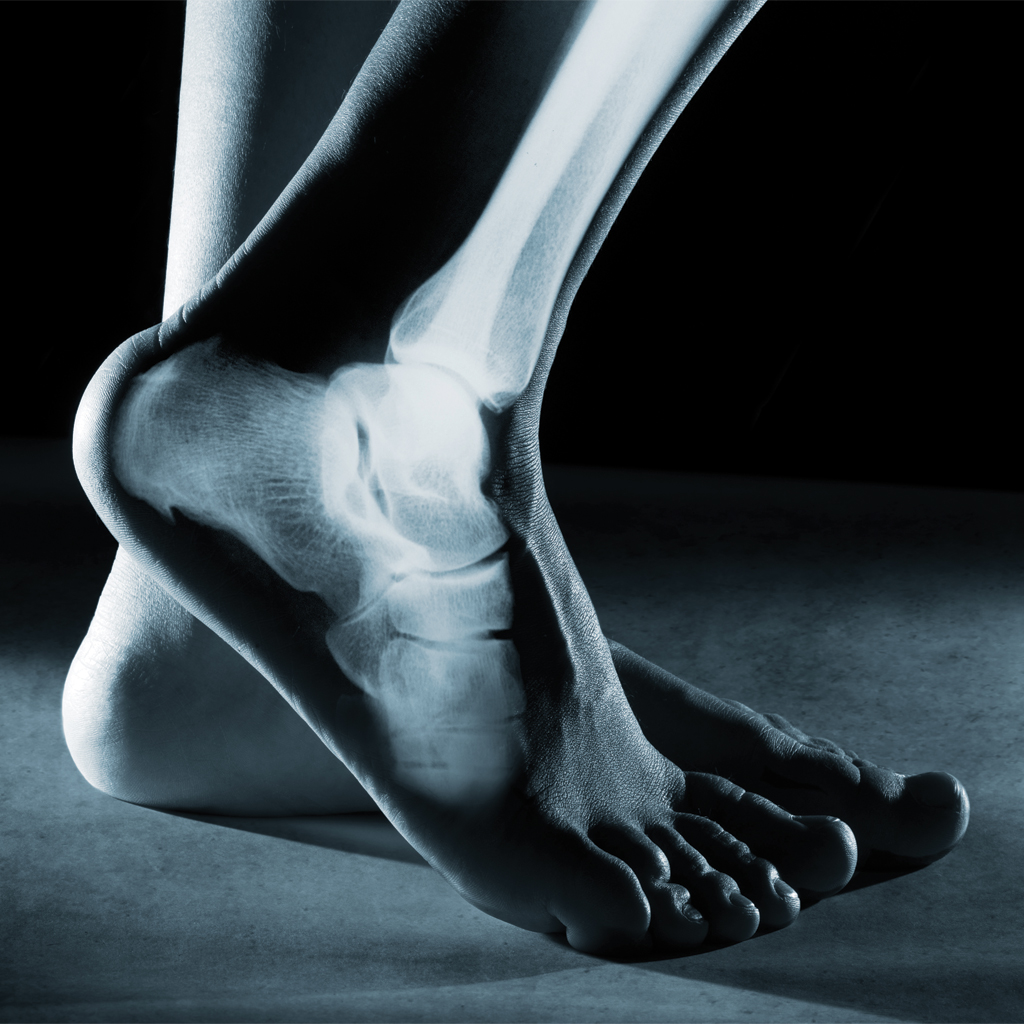 foot x-ray - Plantar Fasciitis Surgery - california