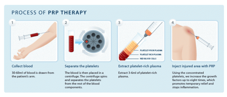 prp therapy process